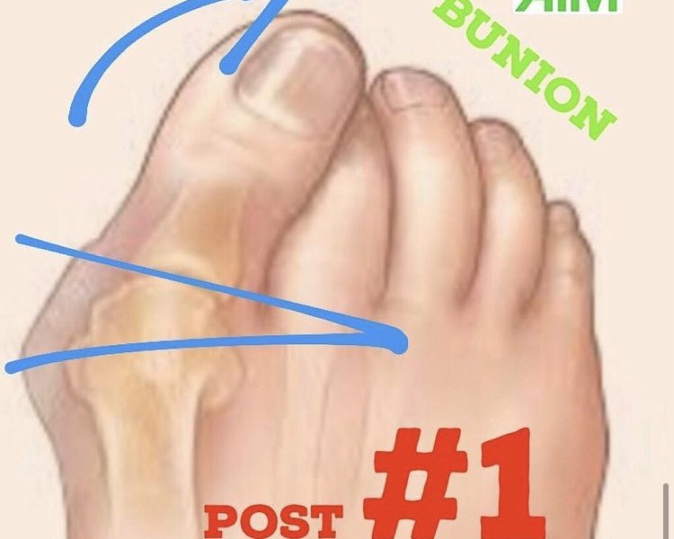 Bunions | Finding Centre