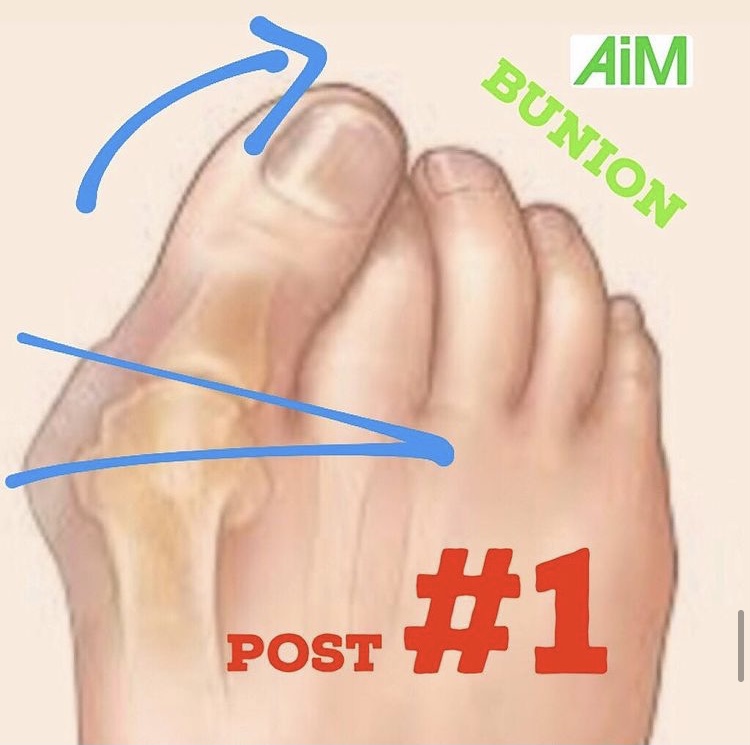 Bunions | Finding Centre